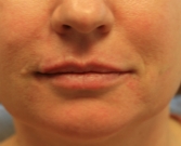 Feel Beautiful - Restylane Defyne Lip Enlargement - After Photo
